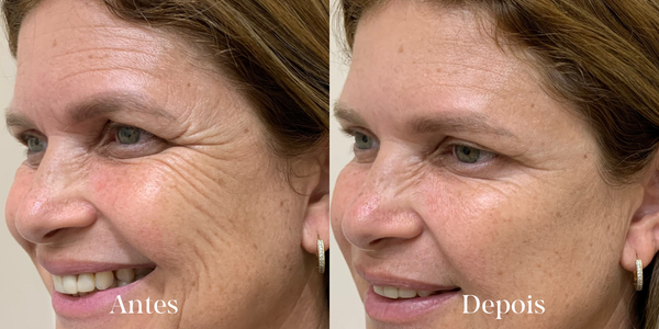 linhas de expressão linhas de expressão